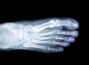 An X-ray of a foot. Runners should consider a biomechanical assessment with a podiatrist