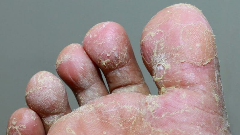 Athlete's foot - tinea pedis, fungal infection