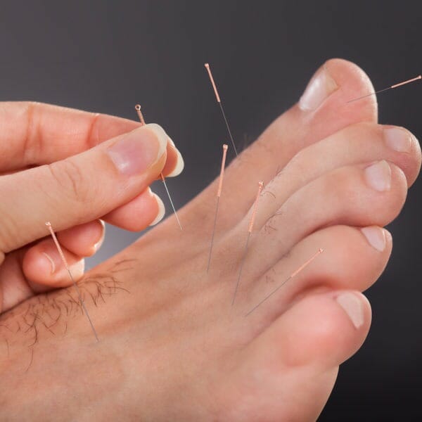 Acupuncture treatments from A Step Ahead Podiatry - foot health and podiatry in Glasgow and Obam