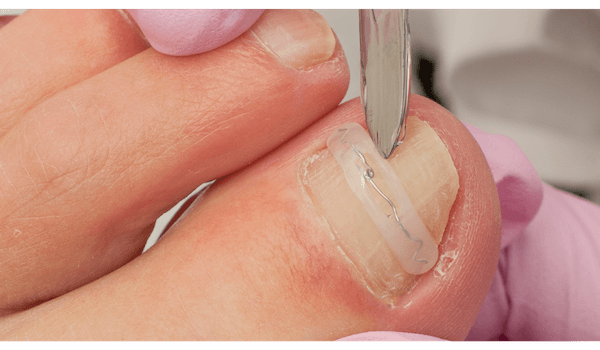Ingrown toenail treatments from A Step Ahead Podiatry - foot health and podiatry in Glasgow and Obam
