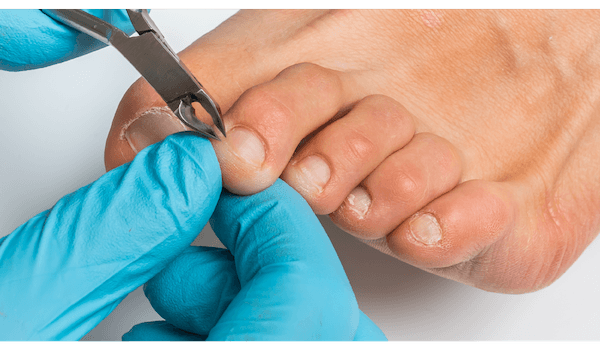 Nail cutting and nail trimming treatments from A Step Ahead Podiatry - foot health and podiatry in Glasgow and Obam