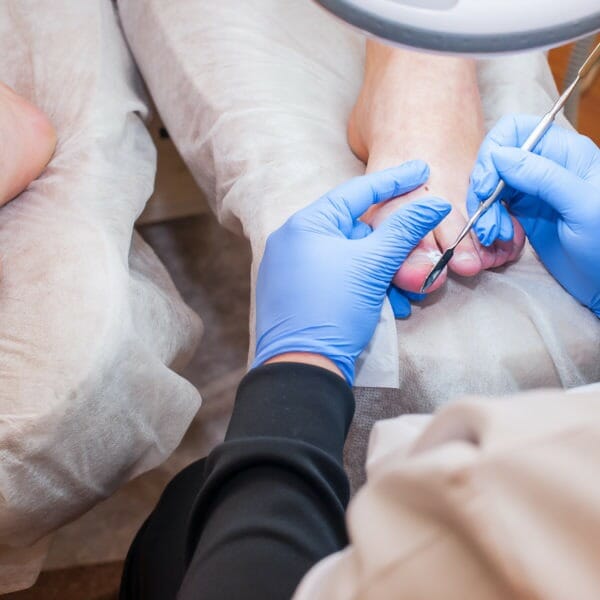 Nail surgery treatments from A Step Ahead Podiatry - foot health and podiatry in Glasgow and Obam